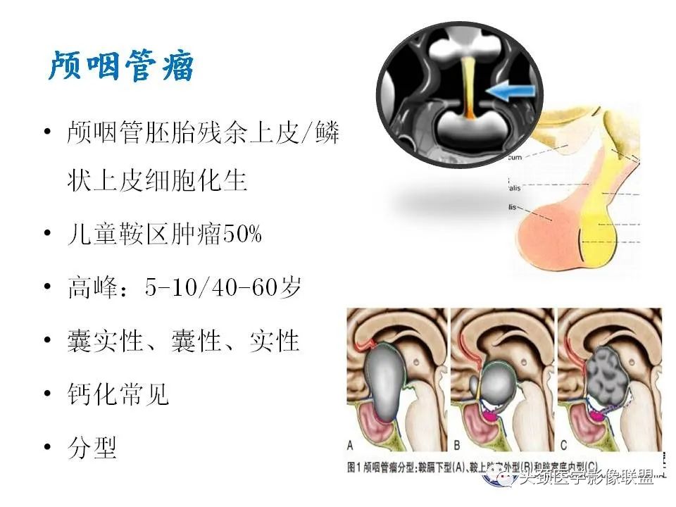 影像PPT - 【PPT】颅内生殖细胞瘤影像诊断及鉴别-33