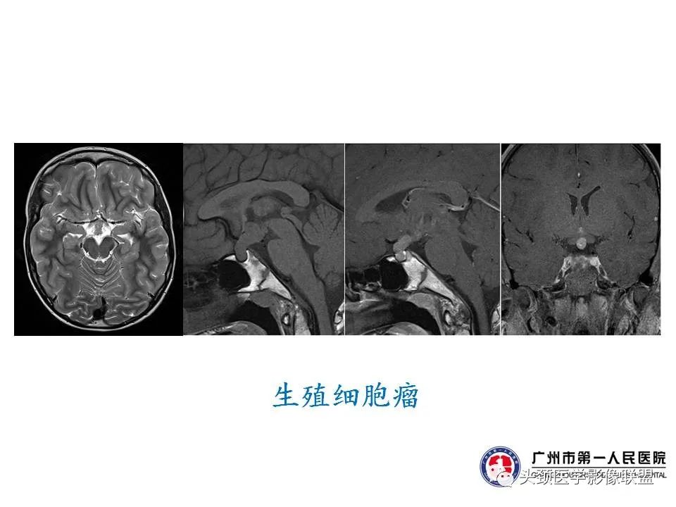 影像PPT - 【PPT】颅内生殖细胞瘤影像诊断及鉴别-32