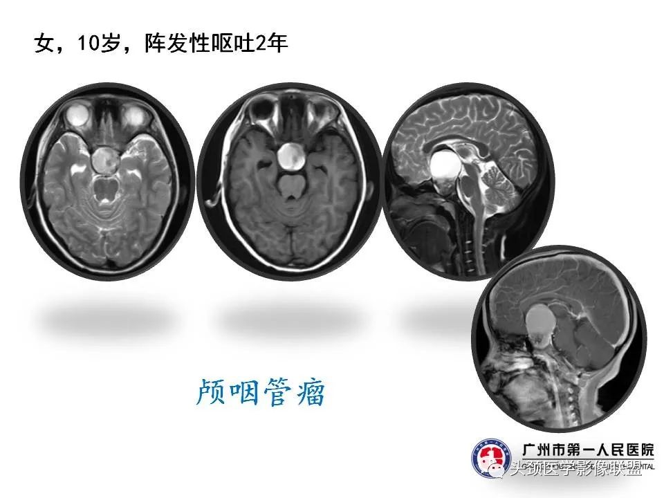影像PPT - 【PPT】颅内生殖细胞瘤影像诊断及鉴别-34