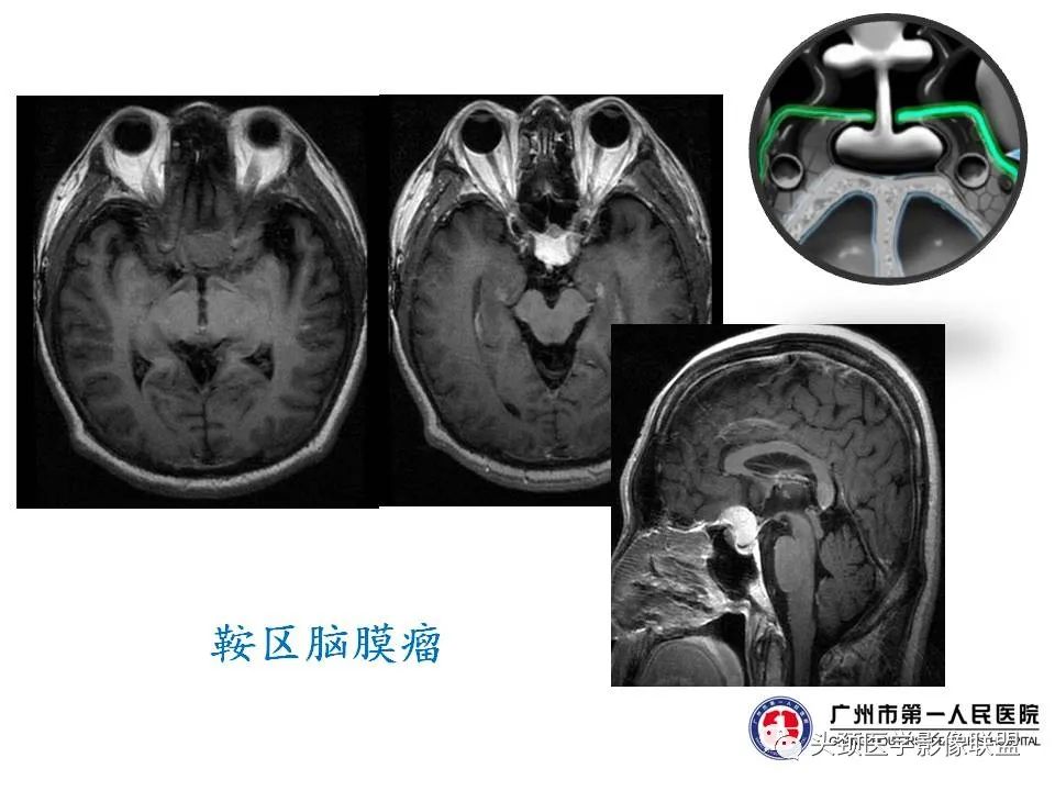 影像PPT - 【PPT】颅内生殖细胞瘤影像诊断及鉴别-36