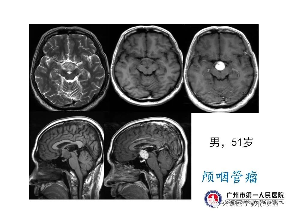 影像PPT - 【PPT】颅内生殖细胞瘤影像诊断及鉴别-35