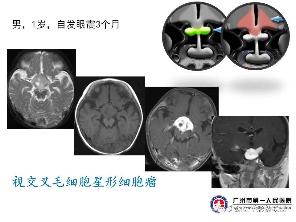 影像PPT - 【PPT】颅内生殖细胞瘤影像诊断及鉴别-37