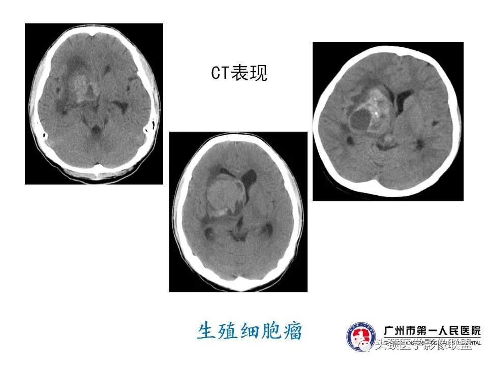 影像PPT - 【PPT】颅内生殖细胞瘤影像诊断及鉴别-42