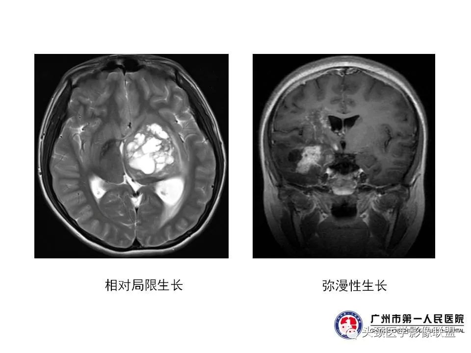 影像PPT - 【PPT】颅内生殖细胞瘤影像诊断及鉴别-41