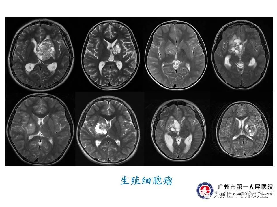 影像PPT - 【PPT】颅内生殖细胞瘤影像诊断及鉴别-43