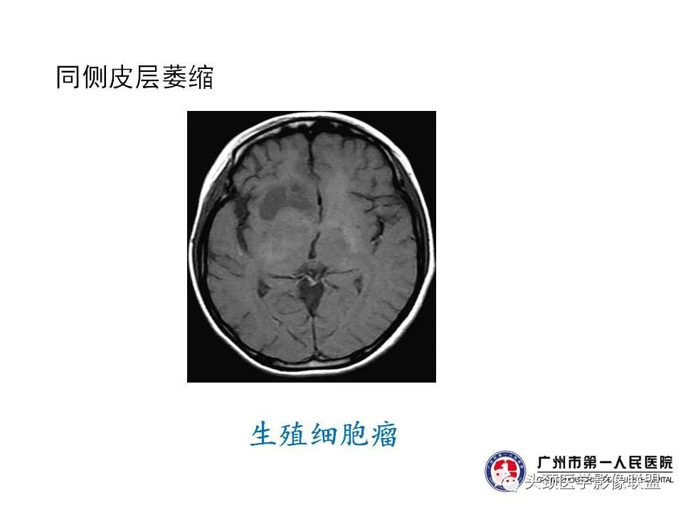 影像PPT - 【PPT】颅内生殖细胞瘤影像诊断及鉴别-47