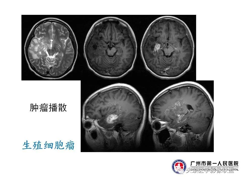 影像PPT - 【PPT】颅内生殖细胞瘤影像诊断及鉴别-44