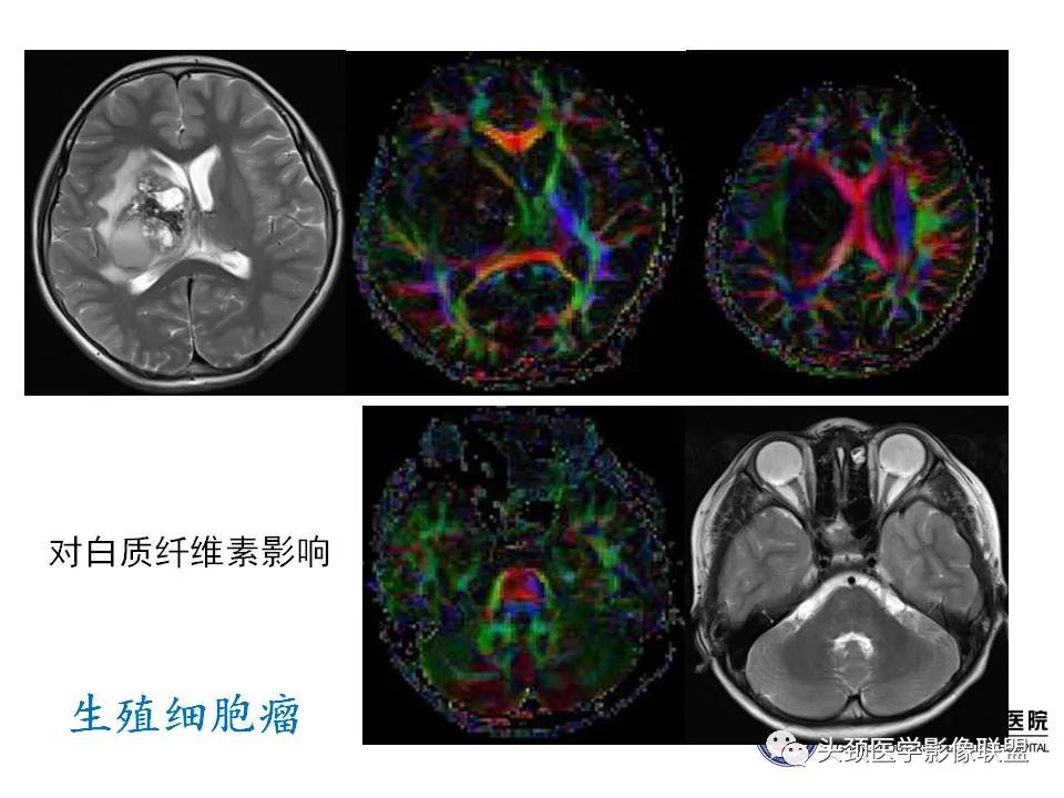 影像PPT - 【PPT】颅内生殖细胞瘤影像诊断及鉴别-46