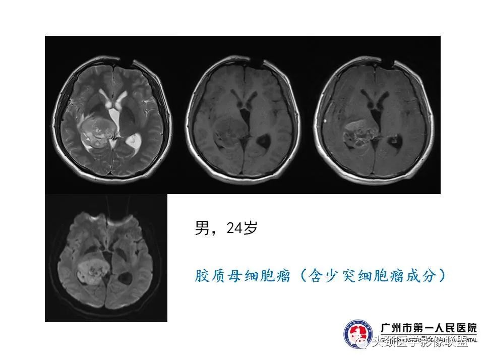 影像PPT - 【PPT】颅内生殖细胞瘤影像诊断及鉴别-49