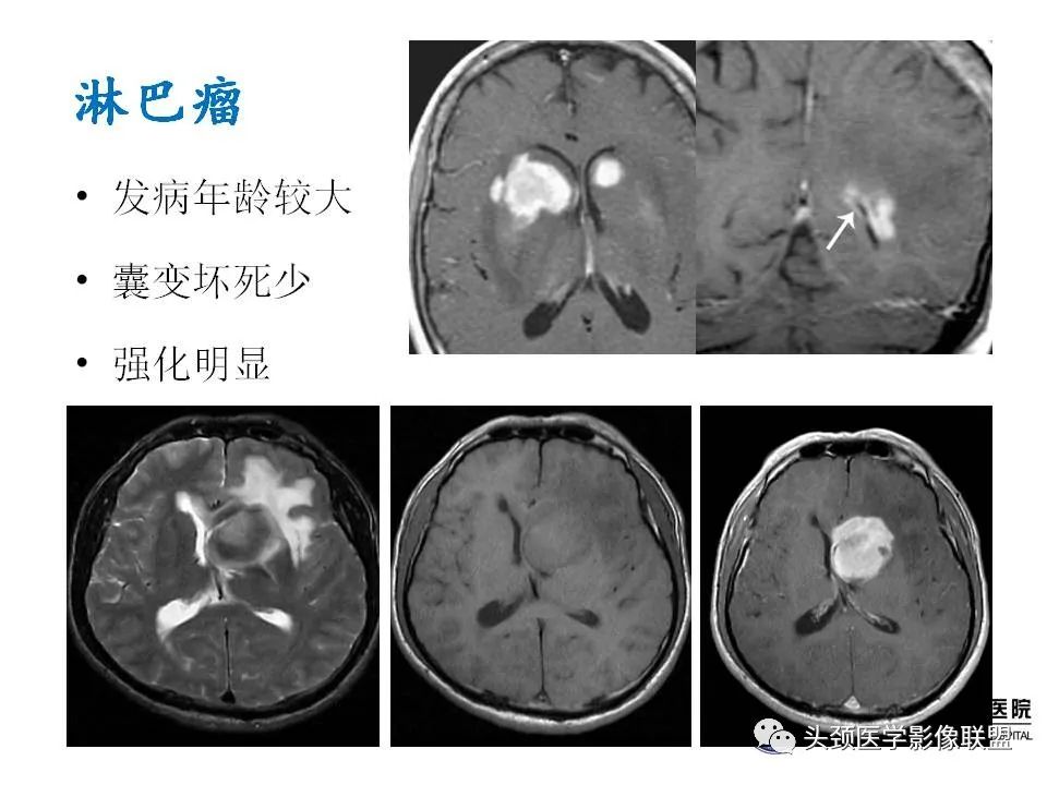 影像PPT - 【PPT】颅内生殖细胞瘤影像诊断及鉴别-50