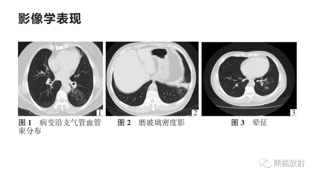 影像PPT - 【病例】肺炎克雷伯杆菌感染2例CT影像-31
