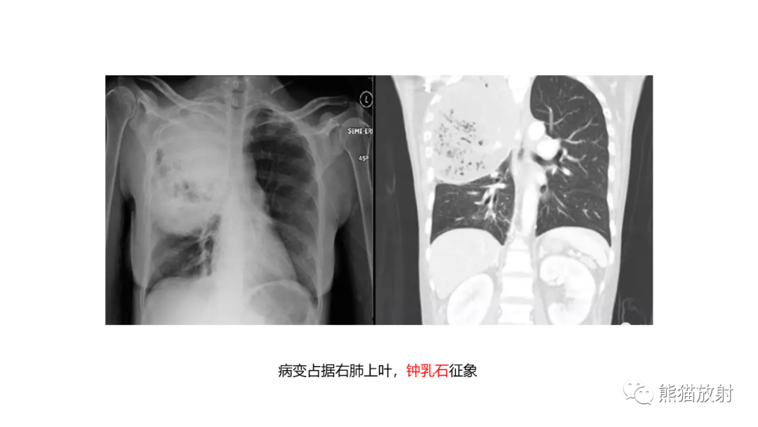 影像PPT - 【病例】肺炎克雷伯杆菌感染2例CT影像-33