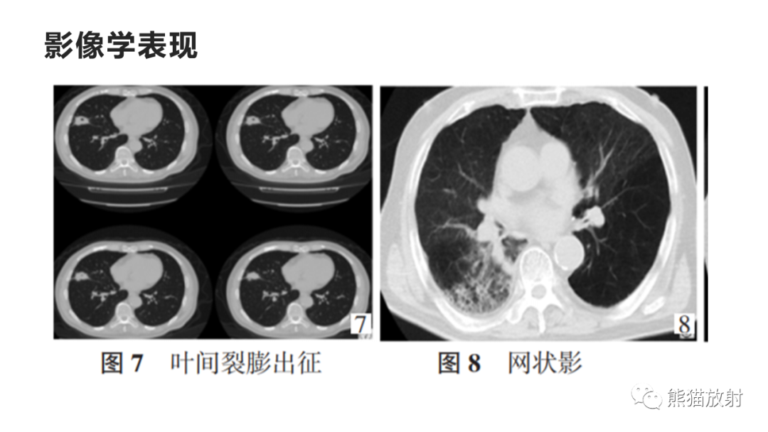 影像PPT - 【病例】肺炎克雷伯杆菌感染2例CT影像-34