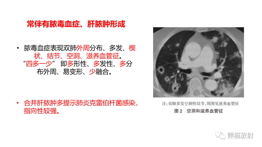 影像PPT - 【病例】肺炎克雷伯杆菌感染2例CT影像-36