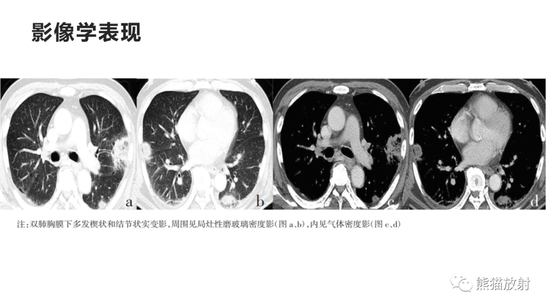 影像PPT - 【病例】肺炎克雷伯杆菌感染2例CT影像-37