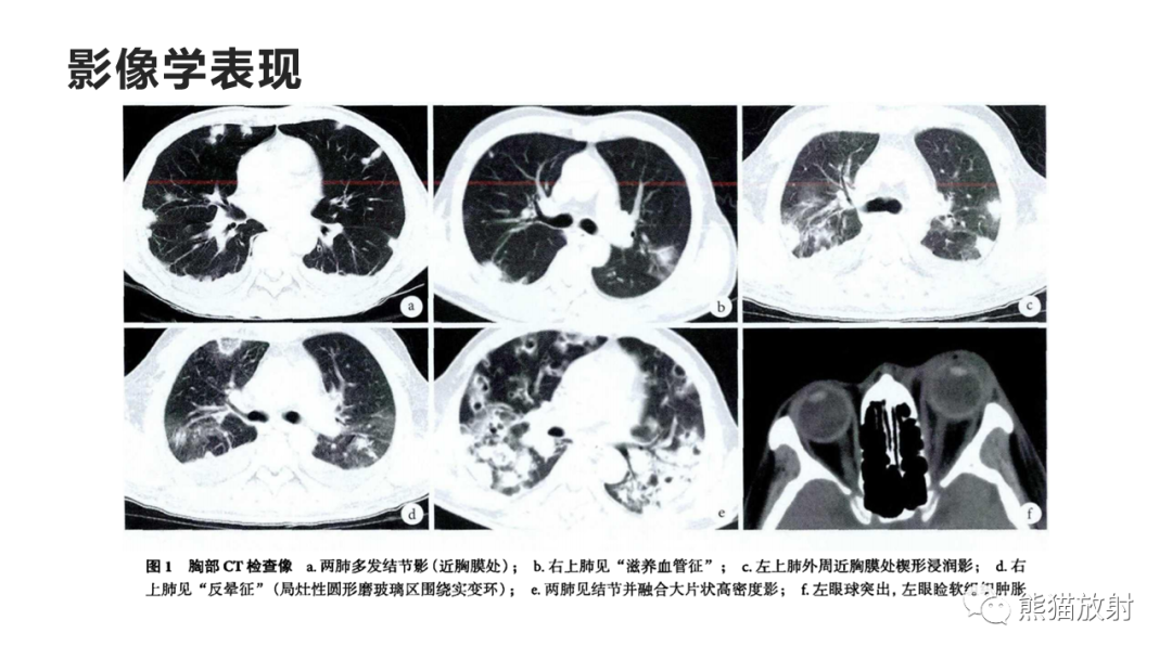 影像PPT - 【病例】肺炎克雷伯杆菌感染2例CT影像-38
