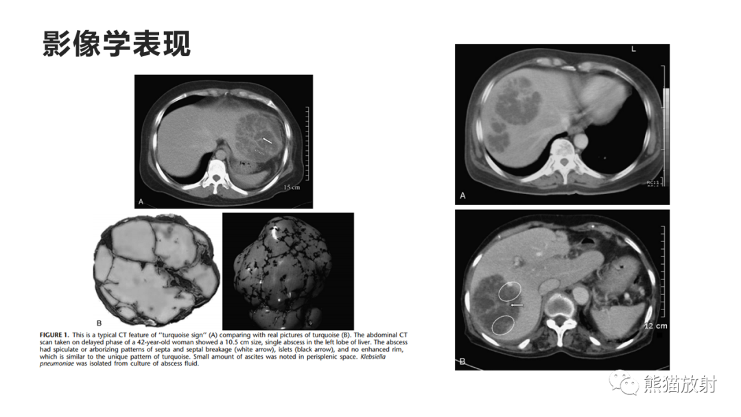 影像PPT - 【病例】肺炎克雷伯杆菌感染2例CT影像-39