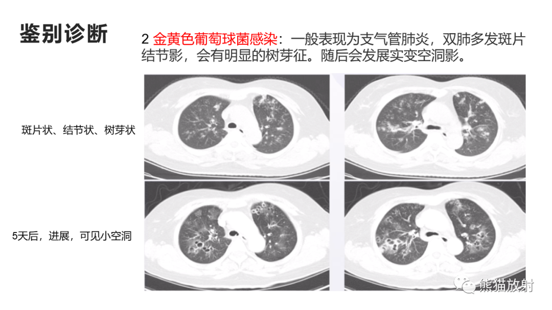 影像PPT - 【病例】肺炎克雷伯杆菌感染2例CT影像-41