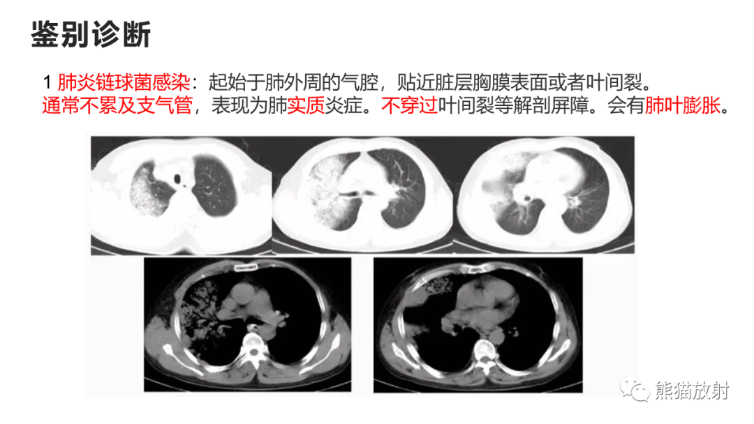 影像PPT - 【病例】肺炎克雷伯杆菌感染2例CT影像-40