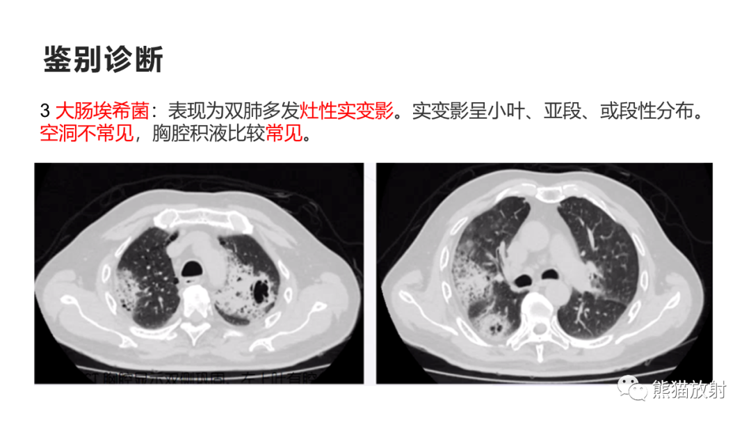 影像PPT - 【病例】肺炎克雷伯杆菌感染2例CT影像-42