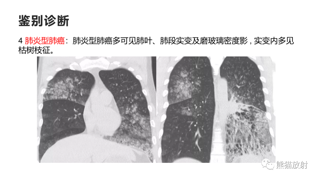 影像PPT - 【病例】肺炎克雷伯杆菌感染2例CT影像-43