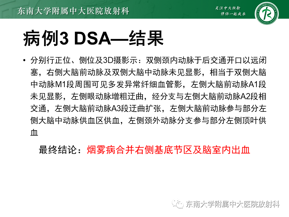 影像PPT - 【病例】脑血管畸形伴出血4例CT及MR影像-14 影像PPT - 【病例】脑血管畸形伴出血4例CT及MR影像-14