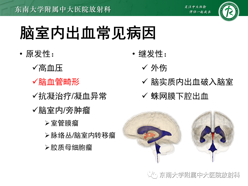 影像PPT - 【病例】脑血管畸形伴出血4例CT及MR影像-17 影像PPT - 【病例】脑血管畸形伴出血4例CT及MR影像-17