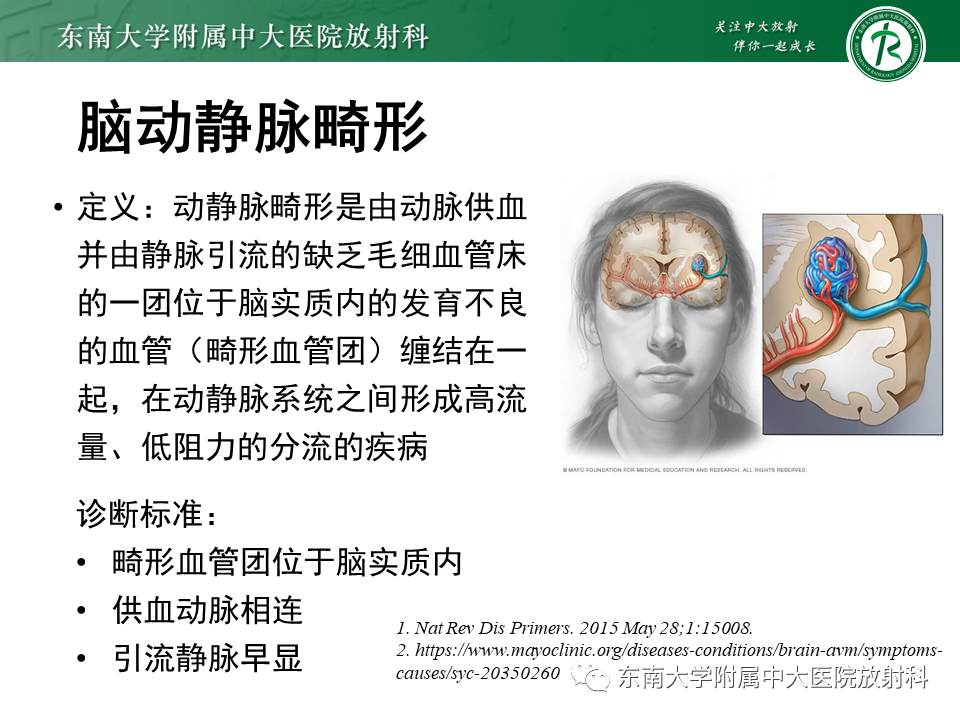 影像PPT - 【病例】脑血管畸形伴出血4例CT及MR影像-21 影像PPT - 【病例】脑血管畸形伴出血4例CT及MR影像-21