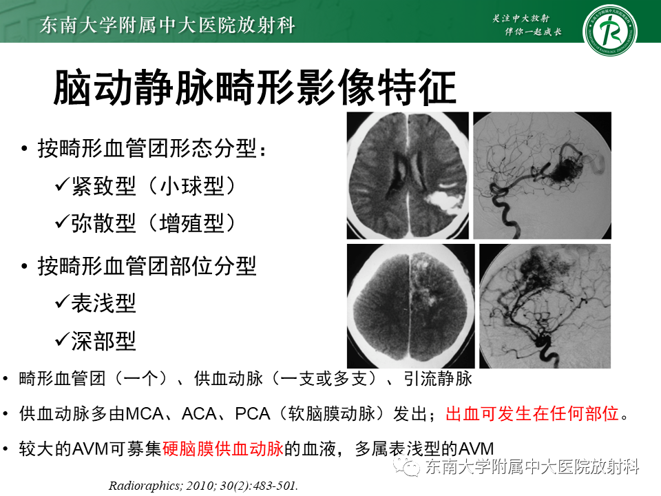 影像PPT - 【病例】脑血管畸形伴出血4例CT及MR影像-22 影像PPT - 【病例】脑血管畸形伴出血4例CT及MR影像-22