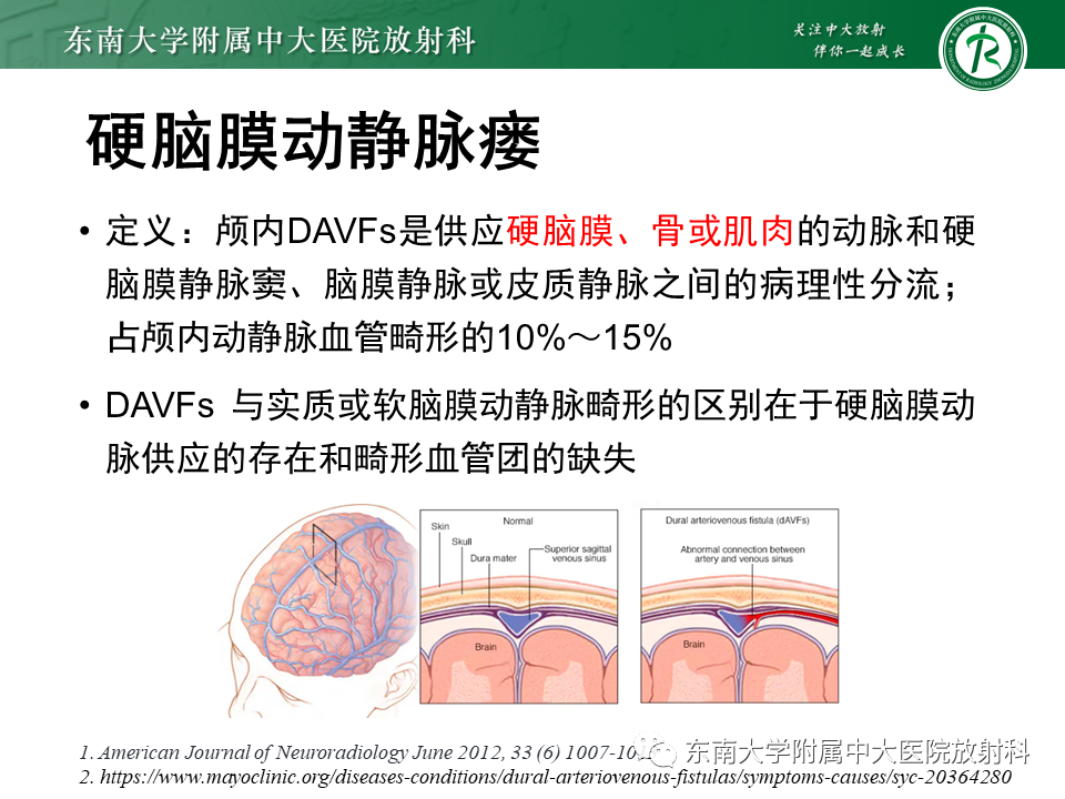 影像PPT - 【病例】脑血管畸形伴出血4例CT及MR影像-25 影像PPT - 【病例】脑血管畸形伴出血4例CT及MR影像-25