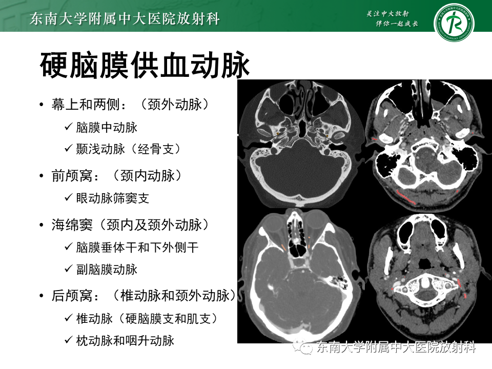 影像PPT - 【病例】脑血管畸形伴出血4例CT及MR影像-26 影像PPT - 【病例】脑血管畸形伴出血4例CT及MR影像-26