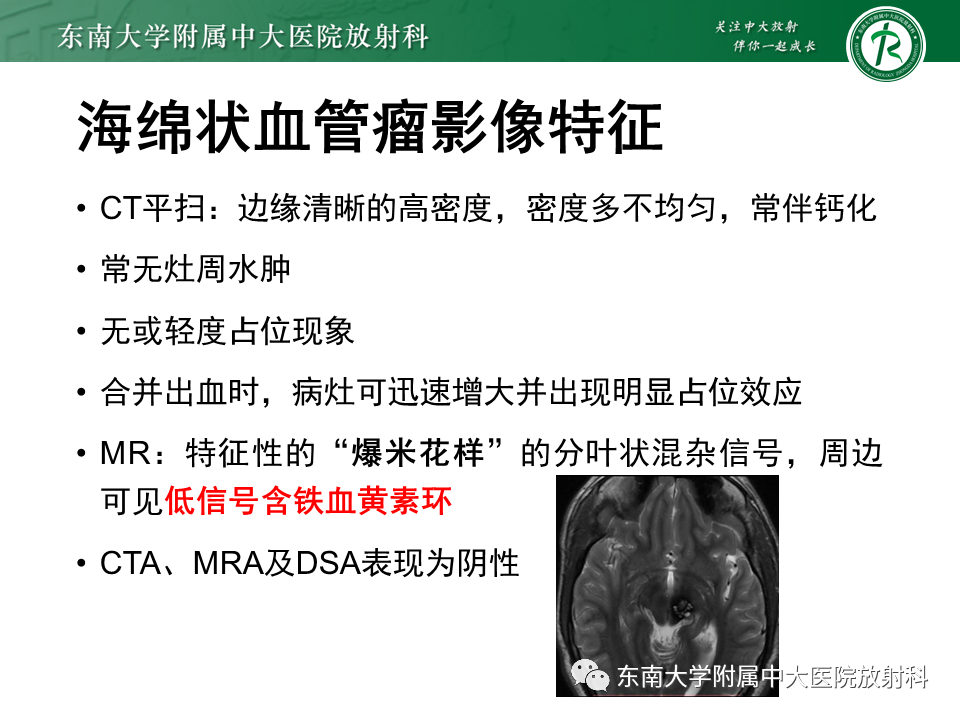 影像PPT - 【病例】脑血管畸形伴出血4例CT及MR影像-33 影像PPT - 【病例】脑血管畸形伴出血4例CT及MR影像-33