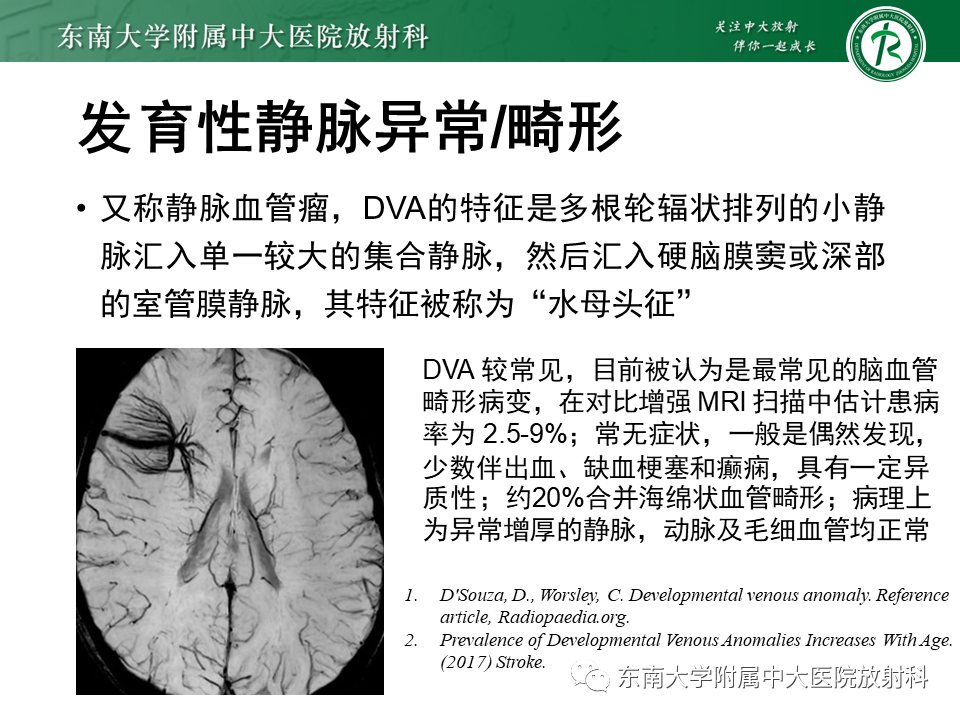 影像PPT - 【病例】脑血管畸形伴出血4例CT及MR影像-35 影像PPT - 【病例】脑血管畸形伴出血4例CT及MR影像-35