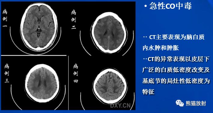 影像PPT - 一氧化碳中毒性脑病-5 影像PPT - 一氧化碳中毒性脑病-5