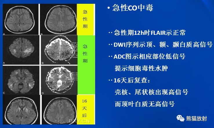 影像PPT - 一氧化碳中毒性脑病-6 影像PPT - 一氧化碳中毒性脑病-6