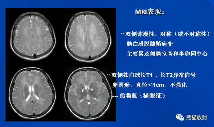 影像PPT - 一氧化碳中毒性脑病-11 影像PPT - 一氧化碳中毒性脑病-11