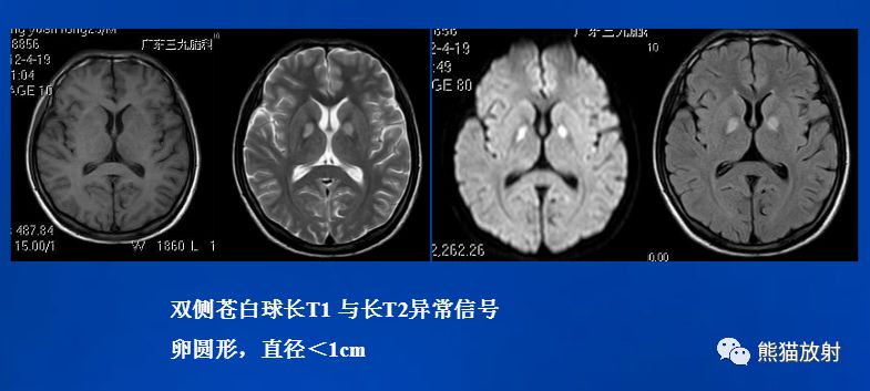 影像PPT - 一氧化碳中毒性脑病-13 影像PPT - 一氧化碳中毒性脑病-13