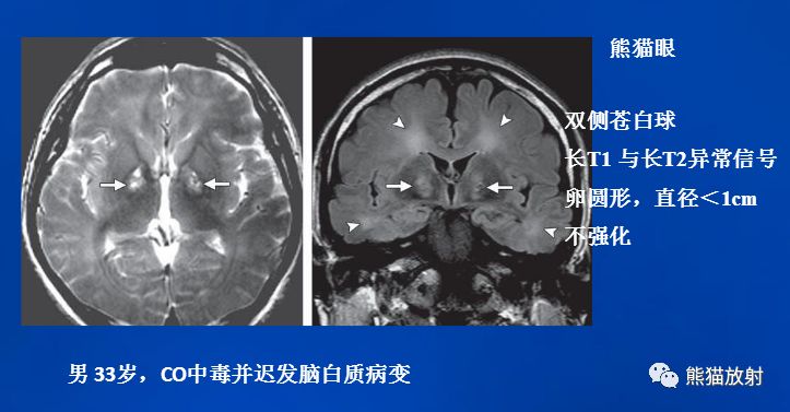 影像PPT - 一氧化碳中毒性脑病-12 影像PPT - 一氧化碳中毒性脑病-12