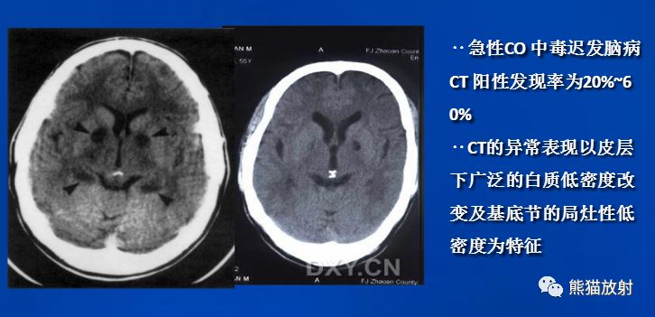 影像PPT - 一氧化碳中毒性脑病-10 影像PPT - 一氧化碳中毒性脑病-10