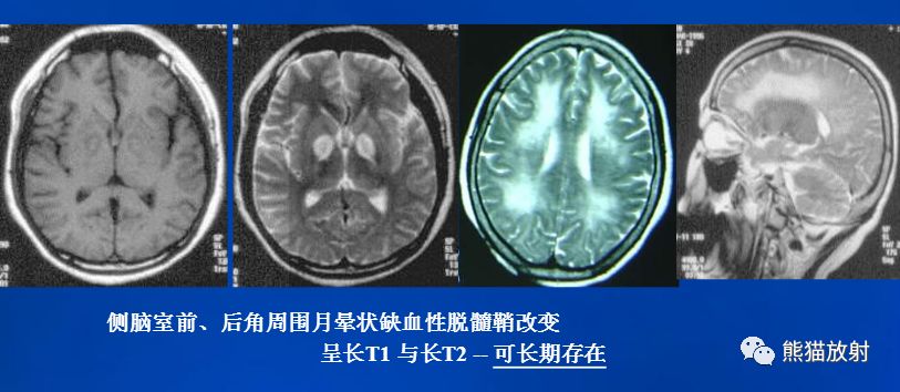 影像PPT - 一氧化碳中毒性脑病-14 影像PPT - 一氧化碳中毒性脑病-14