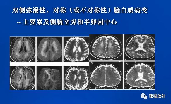 影像PPT - 一氧化碳中毒性脑病-16 影像PPT - 一氧化碳中毒性脑病-16