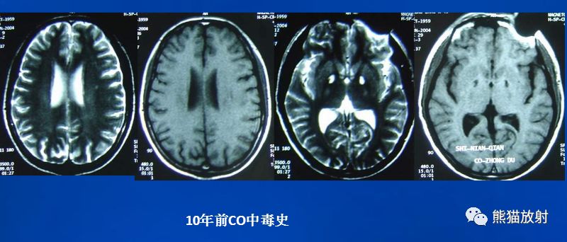 影像PPT - 一氧化碳中毒性脑病-15 影像PPT - 一氧化碳中毒性脑病-15