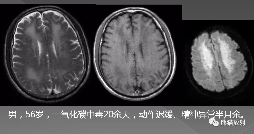影像PPT - 一氧化碳中毒性脑病-17 影像PPT - 一氧化碳中毒性脑病-17