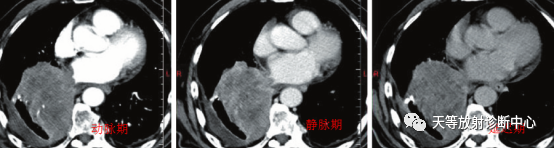 影像PPT - 小细胞肺癌SCLC影像学诊断-2 影像PPT - 小细胞肺癌SCLC影像学诊断-2