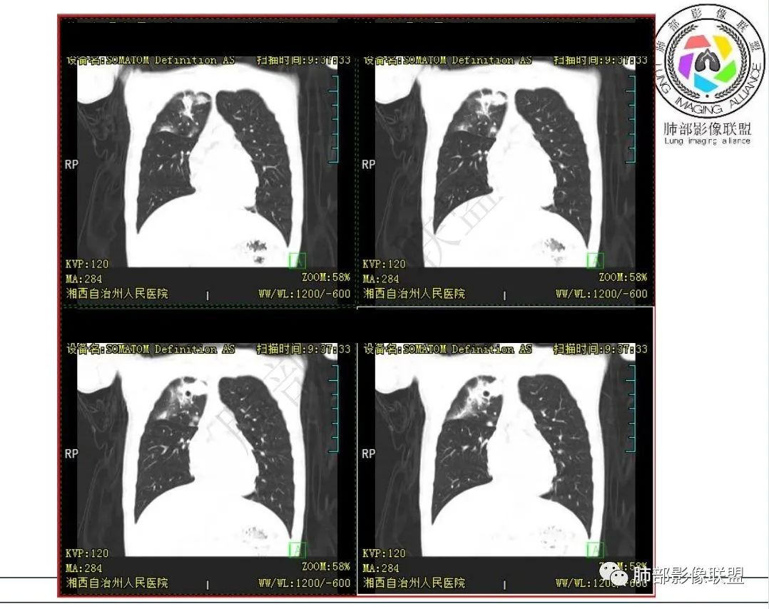 影像PPT - 【病例】 青少年肺隐球菌病1例CT影像-31