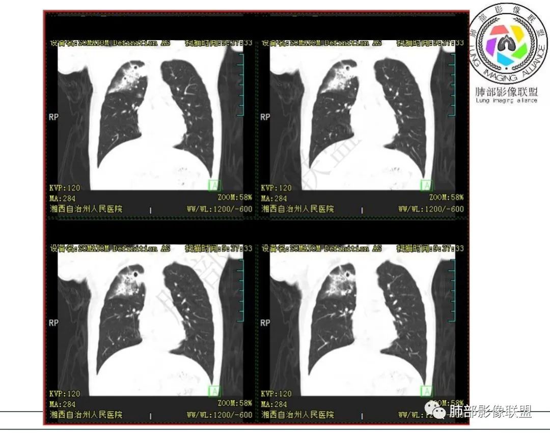影像PPT - 【病例】 青少年肺隐球菌病1例CT影像-32