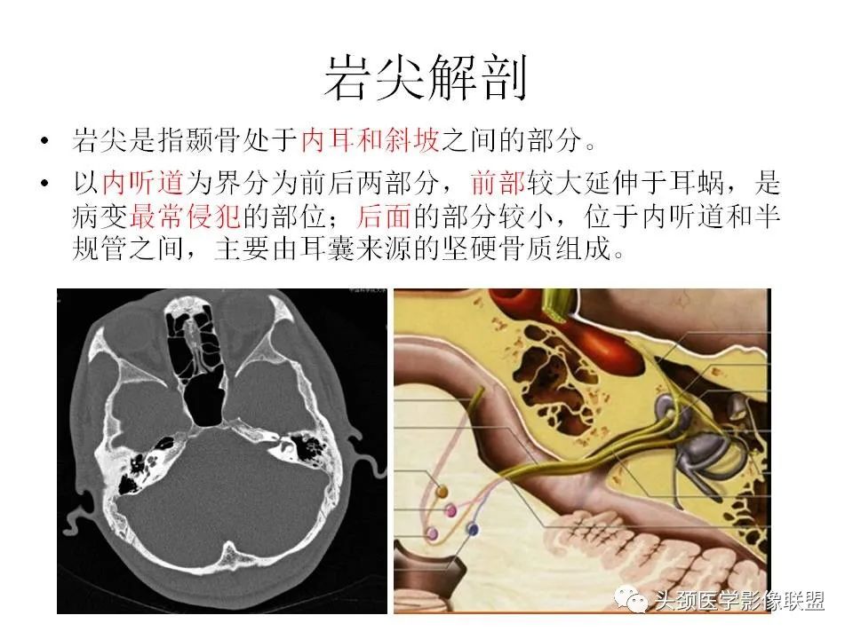 影像PPT - 【PPT】岩尖解剖及常见病变的影像学表现-2
