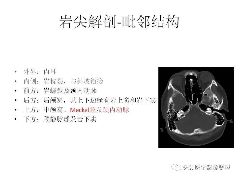影像PPT - 【PPT】岩尖解剖及常见病变的影像学表现-3