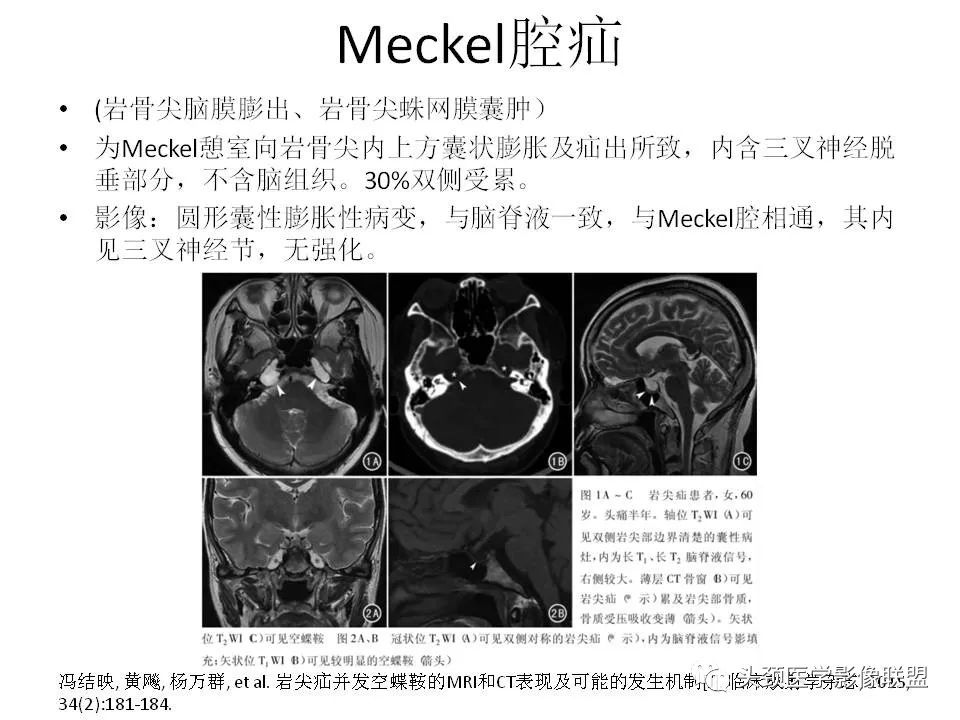 影像PPT - 【PPT】岩尖解剖及常见病变的影像学表现-5