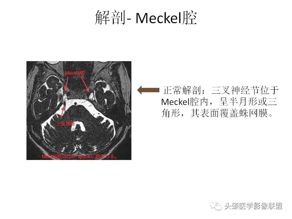 影像PPT - 【PPT】岩尖解剖及常见病变的影像学表现-4